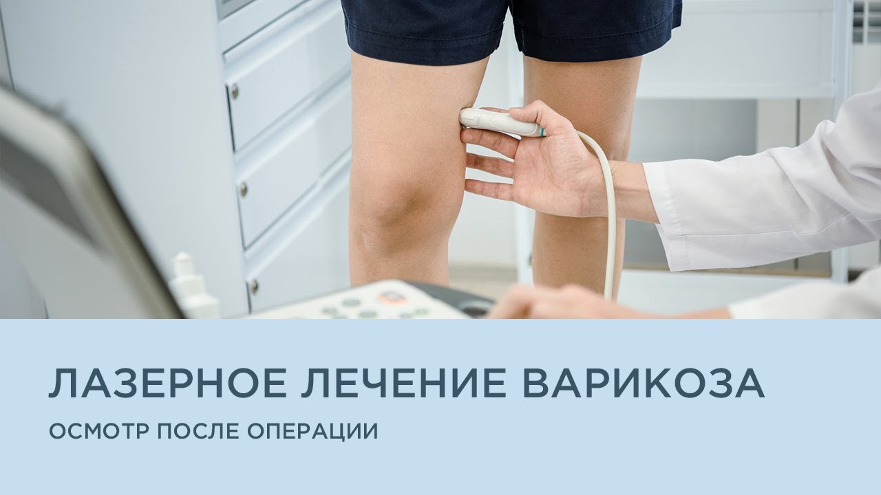 Лазерное лечение варикоза. Осмотр после операции (контроль через 2 месяца)