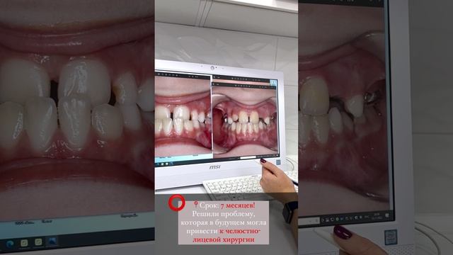 Установка небного расширителя- аппарата Марко Роса.. Разбор кейса