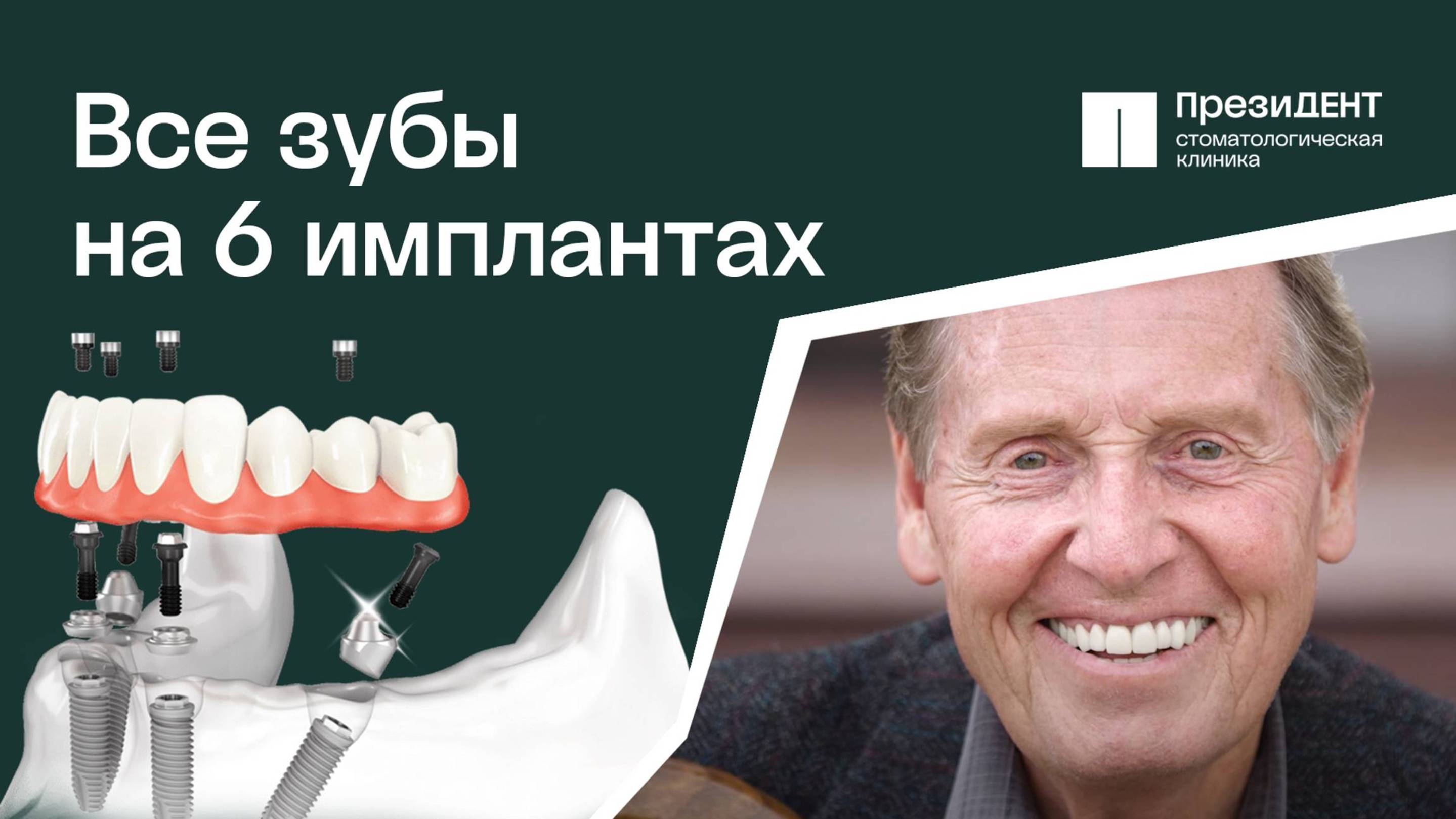 👌🏻  All on 6: как восстановить все зубы? Все о протезировании и имплантации зубов.