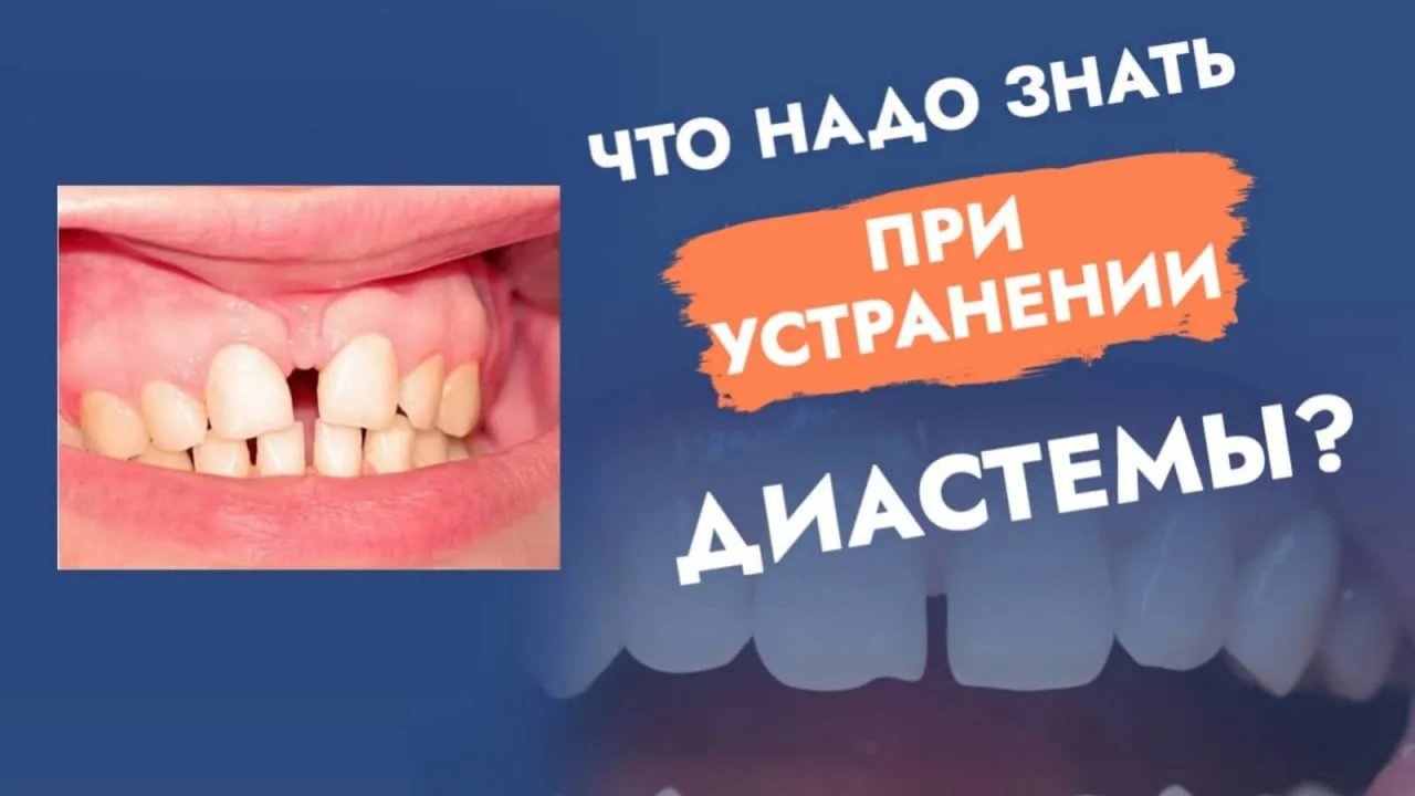 Улыбка Мадонны. Как устранить щербину?