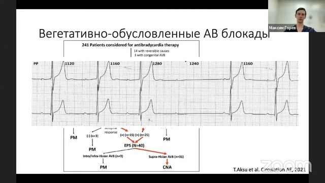 Когда можно обойтись без кардиостимулятора? Новая парадигма в лечении брадиаритмий