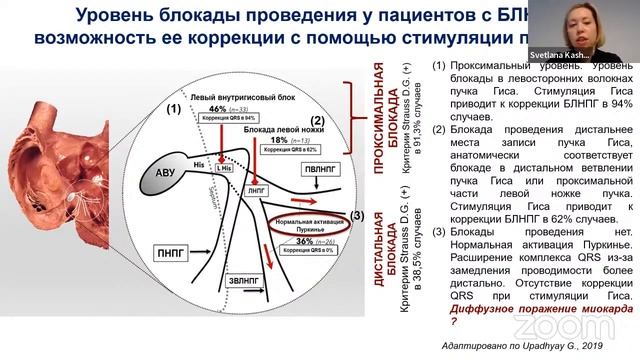 Современные ЭКГ критерии диагностики блокады ЛНПГ. Понятие о проксимальной блокаде ЛНПГ