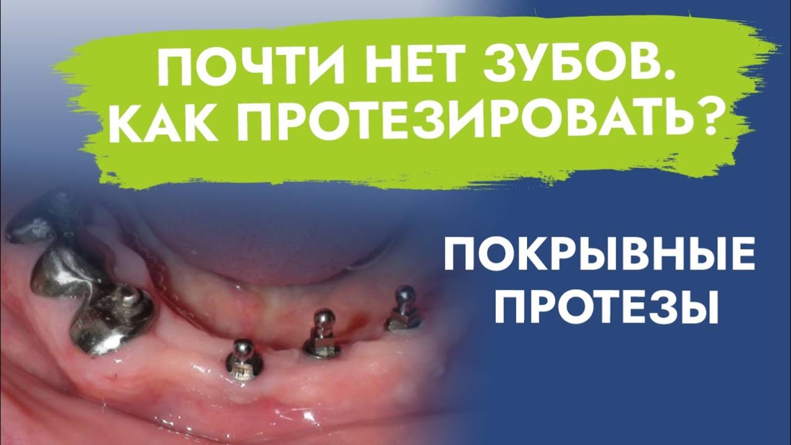 Не стоит торопиться удалять последние зубы!