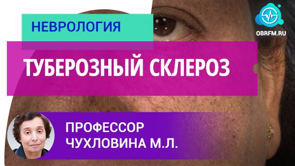 Профессор Чухловина М.Л.: Туберозный склероз
