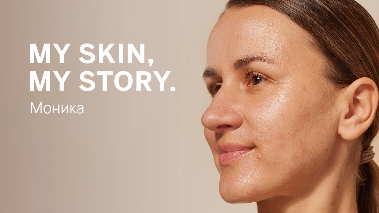 MY SKIN, MY STORY. – Моника