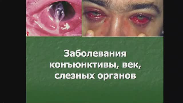 9_50 лекция №3 Заболевания конъюнктивы, век, слезных органов КФУ Медицинская академия Иванова Н В