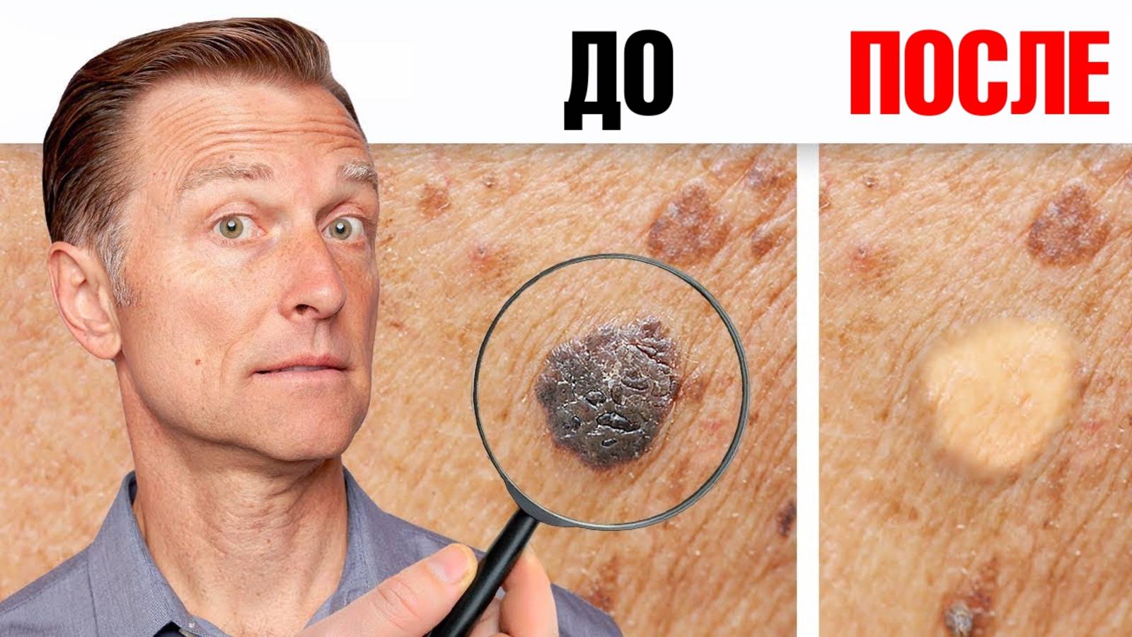 Как избавиться от папиллом и бородавок за ОДНУ ночь?👀