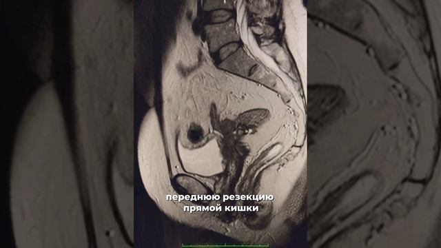 Рецидив рака шейки матки у молодой женщины на снимках МРТ