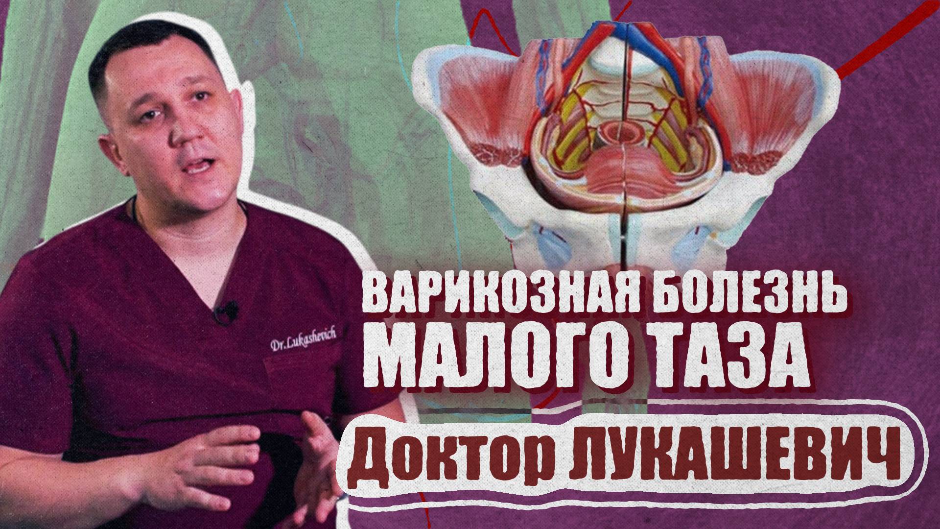 Варикозная болезнь малого таза. Доктор Лукашевич