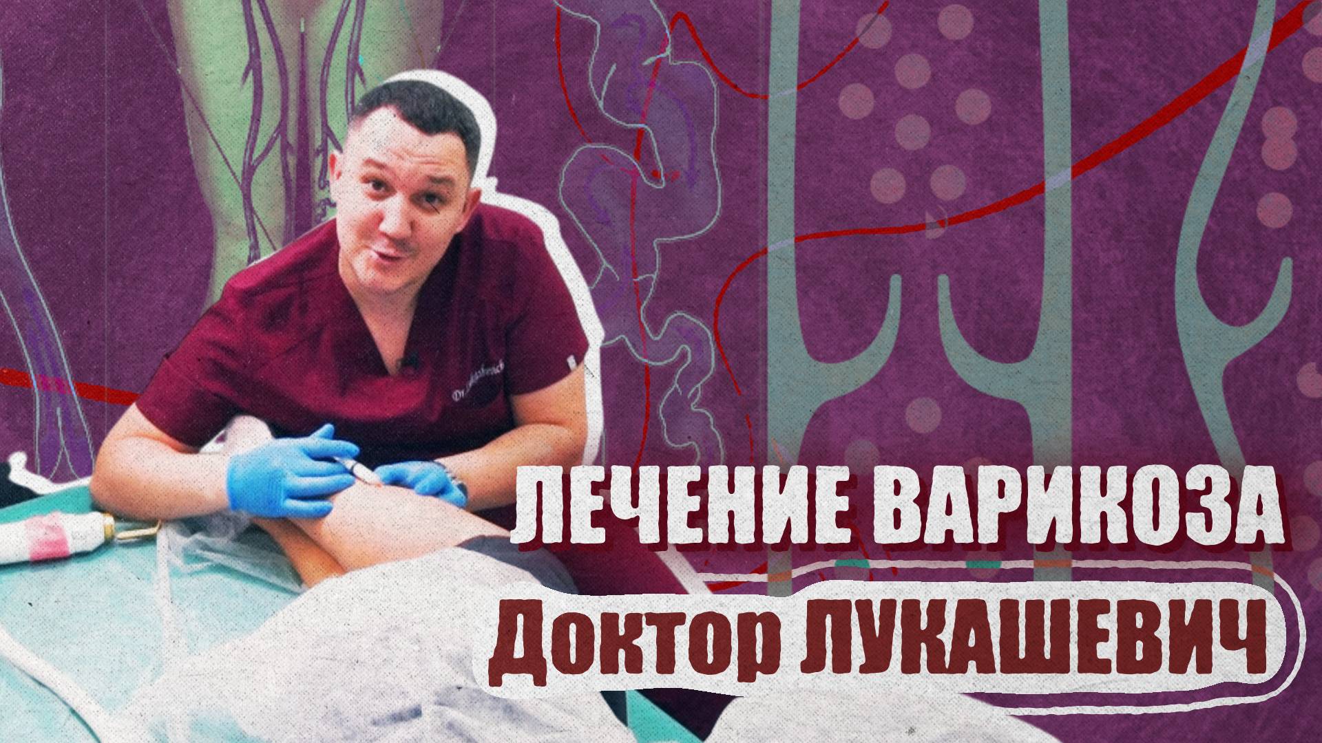 Лечение варикоза. Доктор Лукашевич