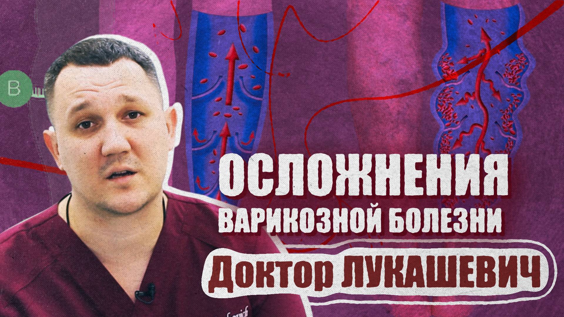 Осложнения варикозной болезни. Доктор Лукашевич