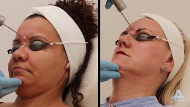 Пикосекундный неодимовый лазер Asclepion PicoStar, пилинг, омоложение