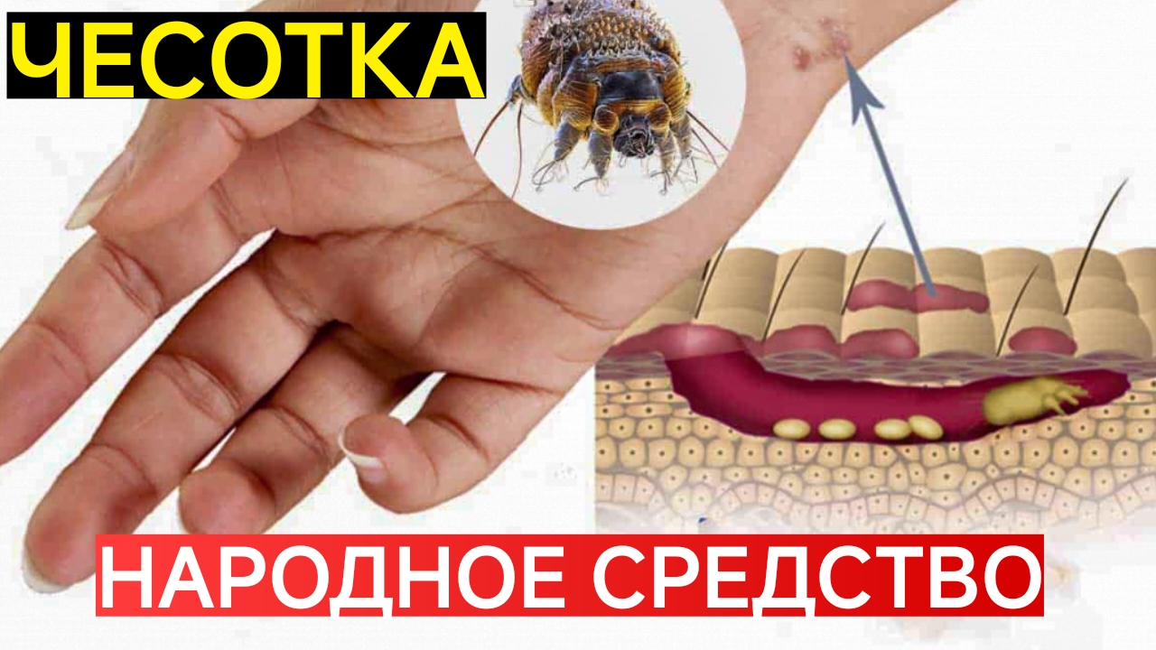 ЧЕСОТКА И ЗУД.СТАРИННОЕ СРЕДСТВО..КАК УСТРАНИТЬ. ЛАЙФХАК