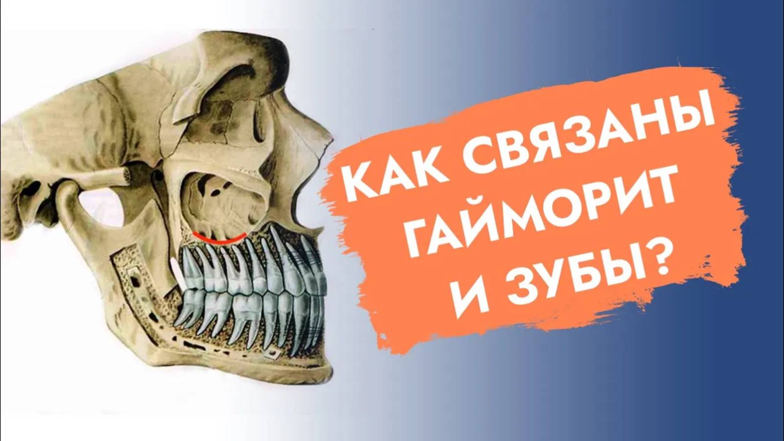 Воспаление гайморовой пазухи может быть связано с зубами!