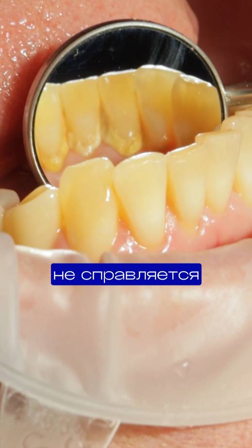 Почему твои зубы грязные даже после чистки?!#гигиеназубов #зубнойналет #чистказубов #зубнойкамень