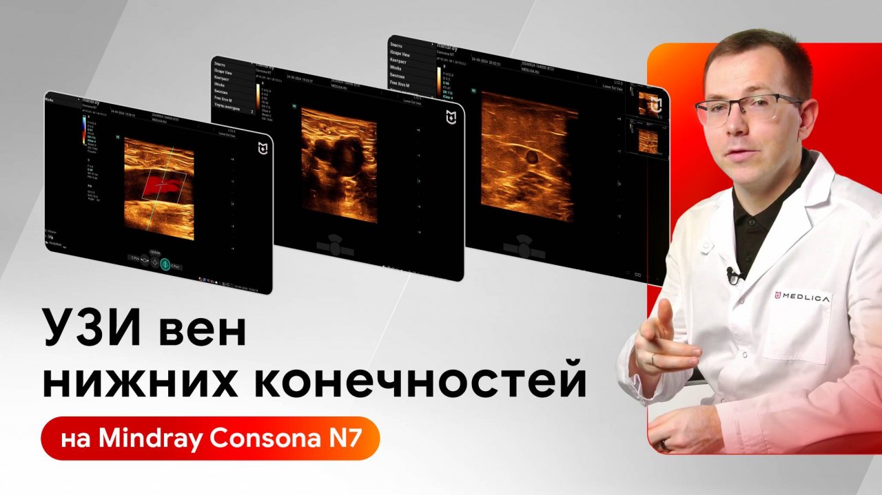 Техника сканирования вен нижних конечностей на Mindray Consona N7
