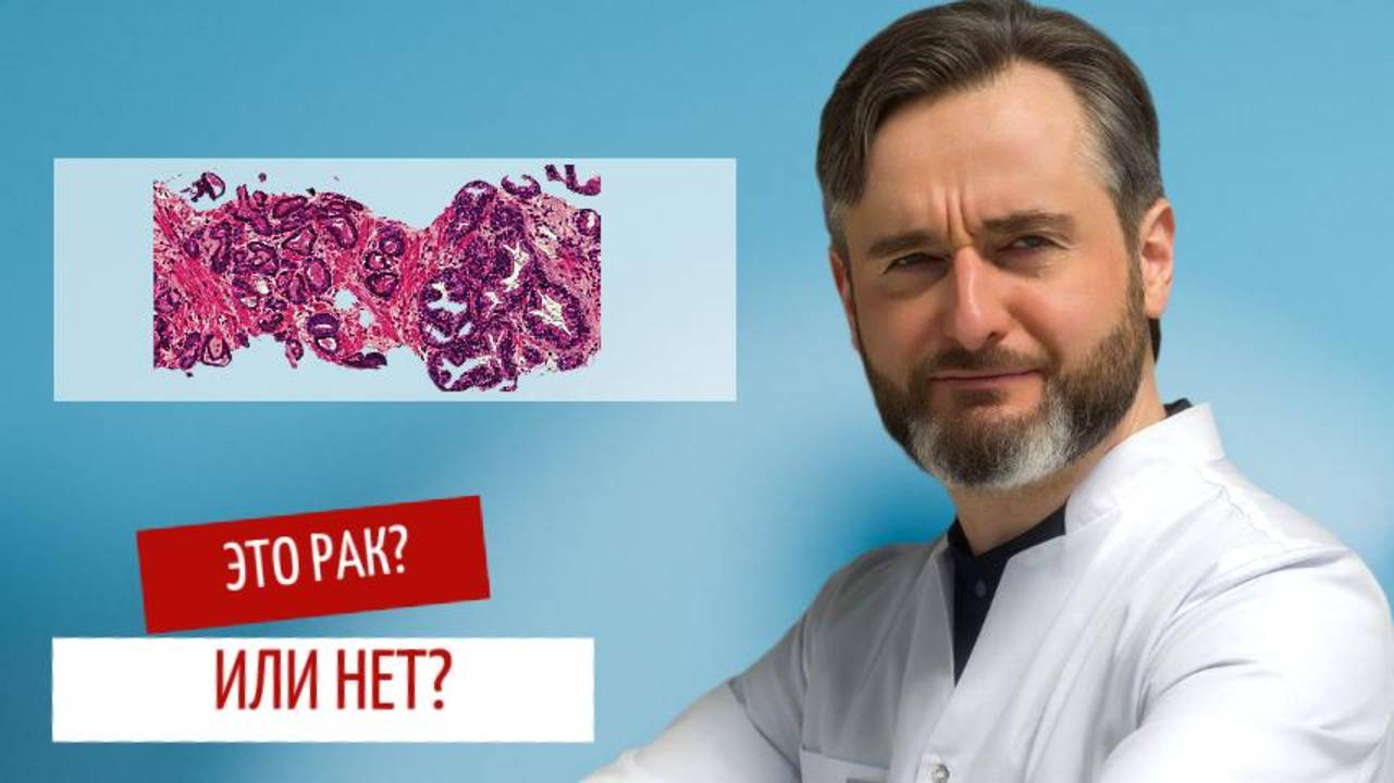 Как не пропустить рак простаты на 1 стадии: советы врача