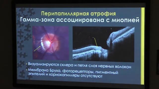 Мониторинг глаукомы с позиций ОКТ