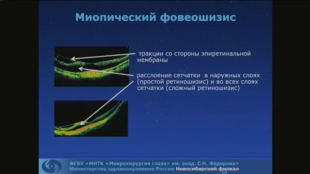 Дулидова В.В. Миопическая макула. ОКТ-диагностика
