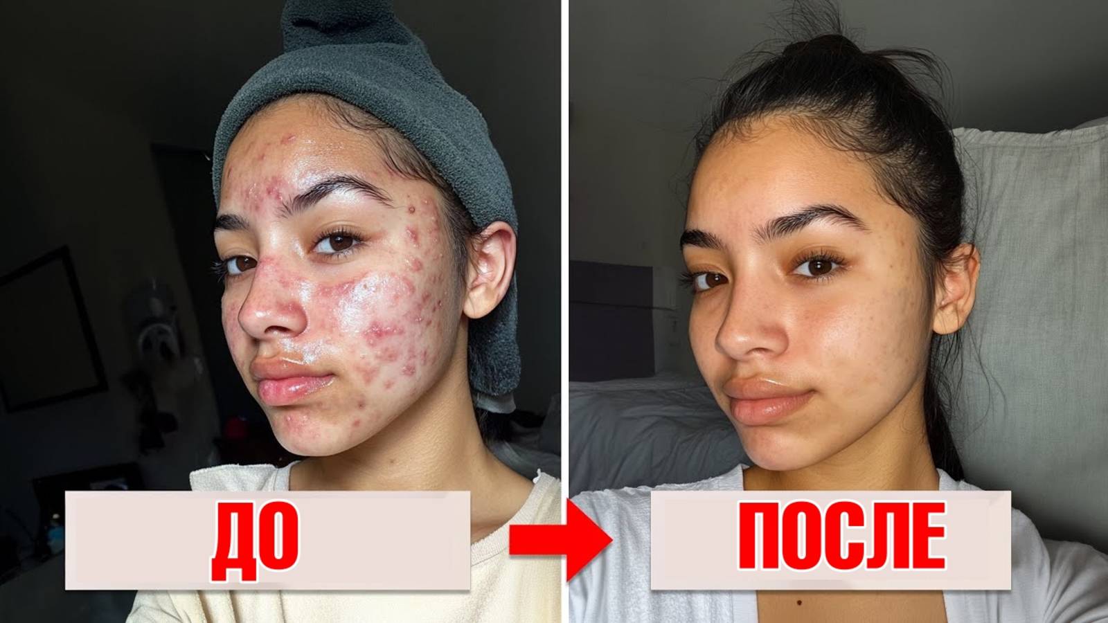 Как избавиться от акне быстрее всего?👀