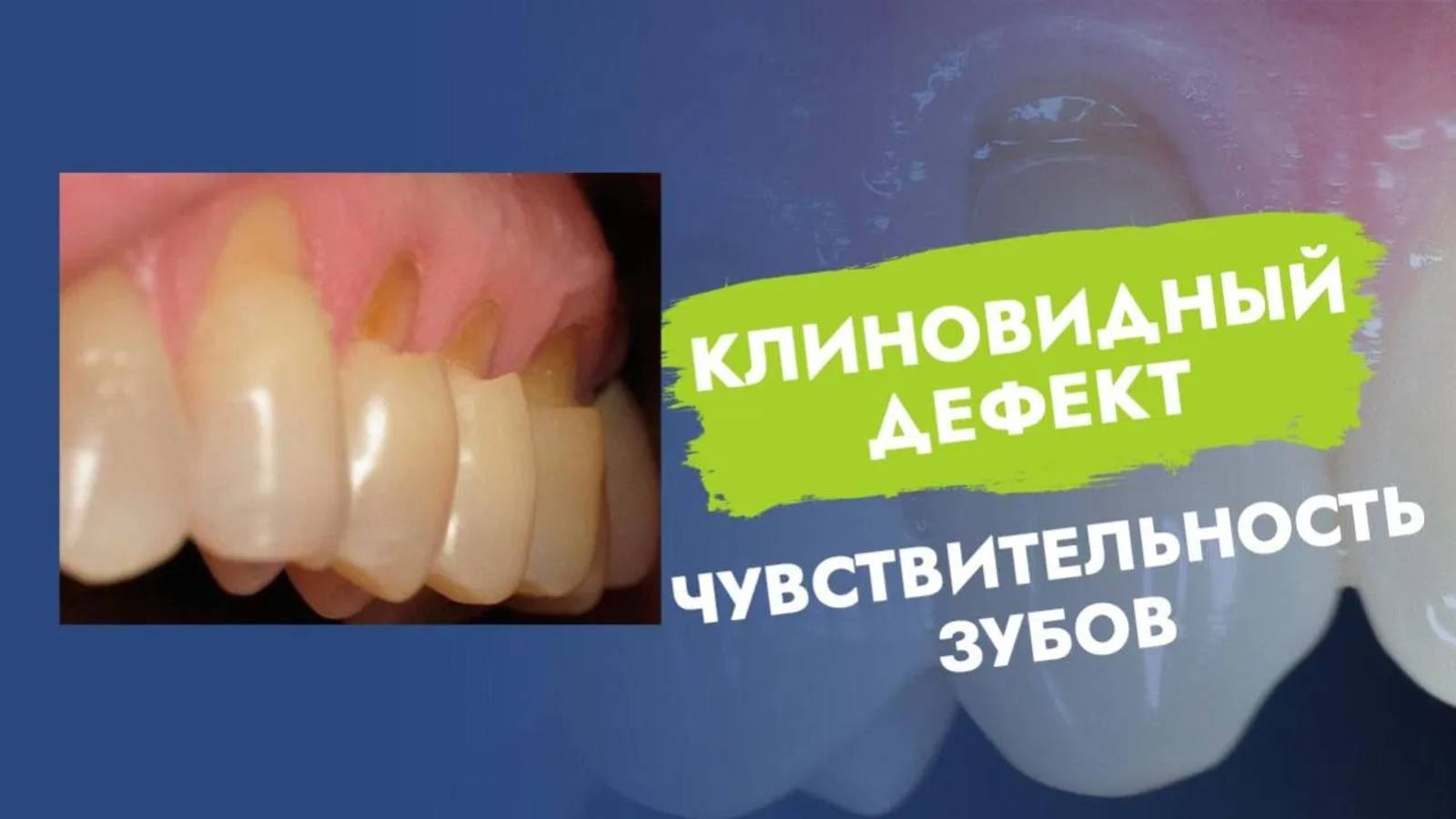 Чувствительность эмали зубов. Оголение шеек!