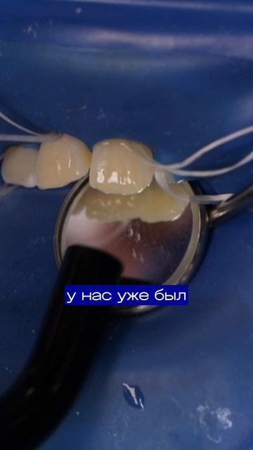 Качели выбили зуб! Убираем последствия травмы зубов за 40 минут #стоматология #зубы #скол #качели