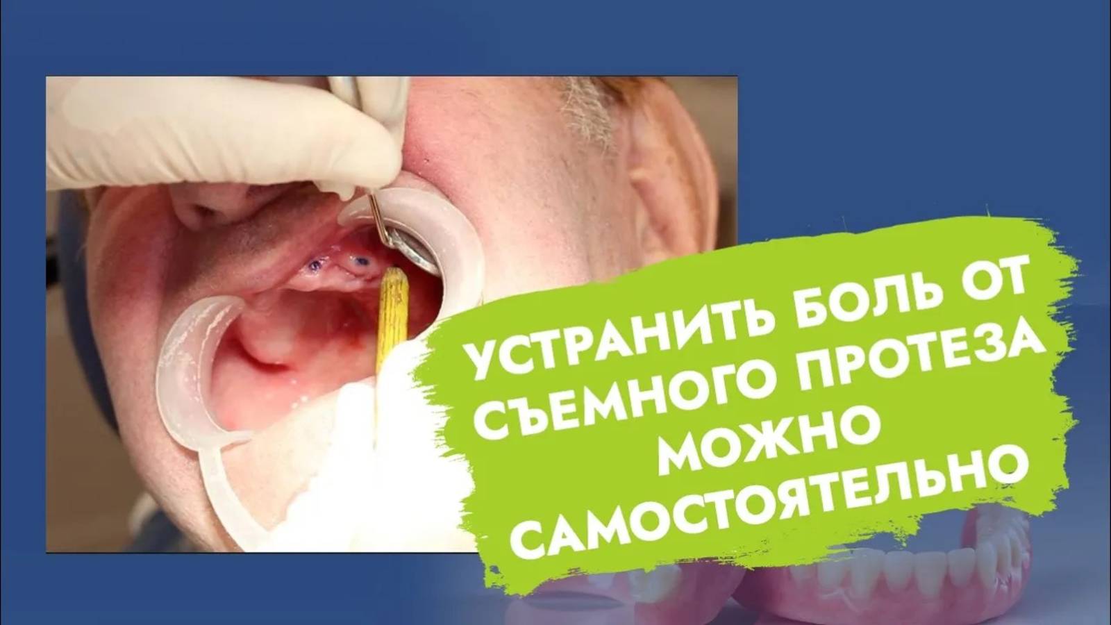 Боль от съемного протеза. Как помочь?
