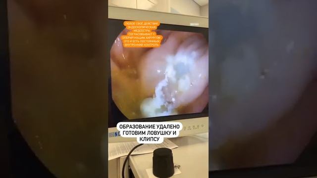 Удаляем новообразование в толстой кишке