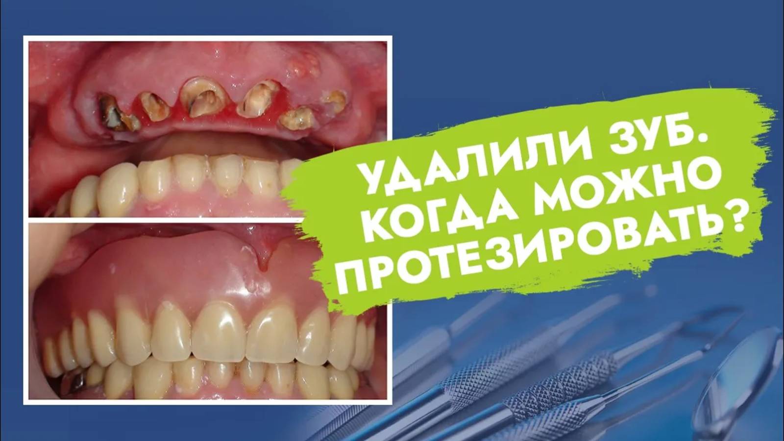 Когда и как можно протезировать после удаления зубов?