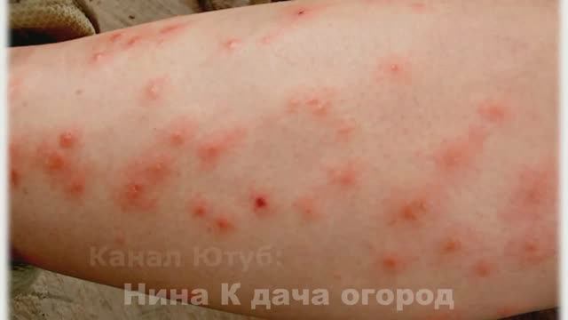 Мошкара: КАК БОРОТЬСЯ С МОШКОЙ И КОМАРАМИ на огороде. Как снять припухлость и кожный зуд при укусе