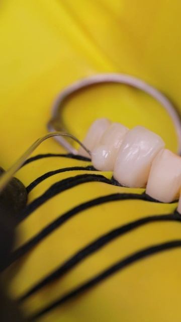 Композитные виниры за 1 визит! Техника Easy-Flow в деталях ✨ #Виниры #Стоматология #красивыезубы