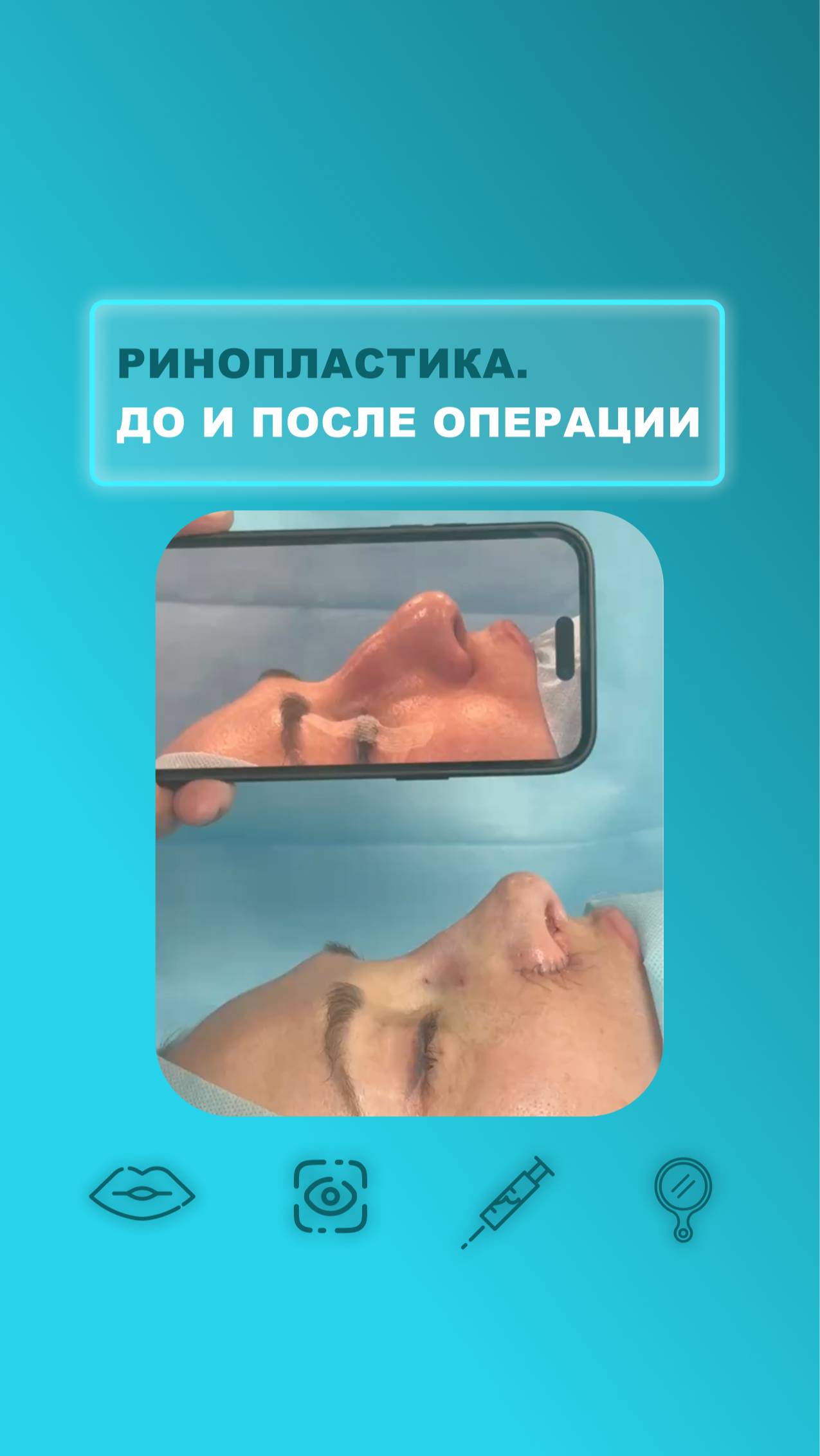 Ринопластика. До и после операции