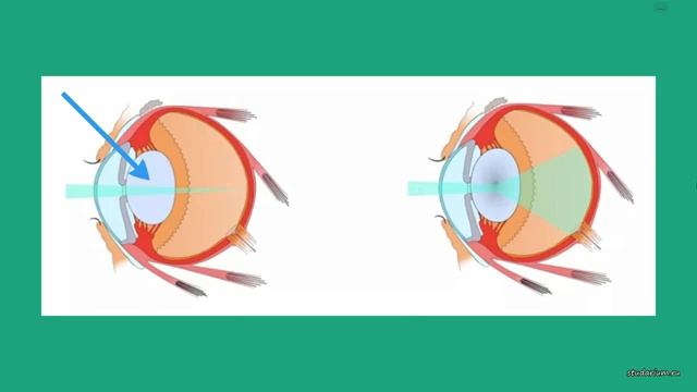 Орган зрения. Анатомия и физиология глаза. Болезни. Лекция и разбор заданий от Юрия Беллевича