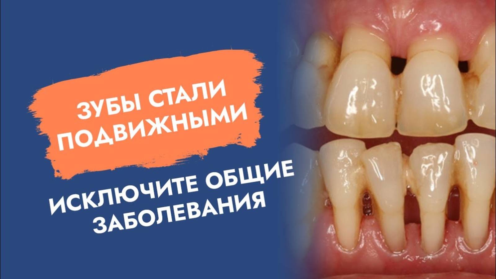 Подвижные зубы предупреждают о больших проблемах!