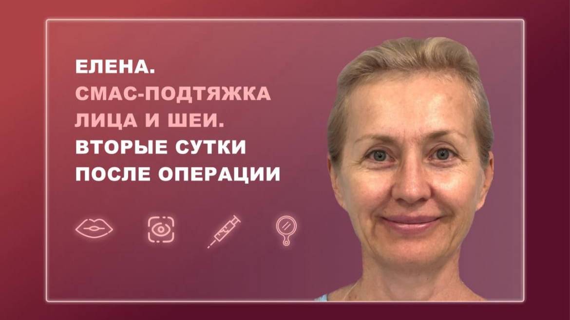 Елена. СМАС-подтяжка лица и шеи. Вторые сутки после операции