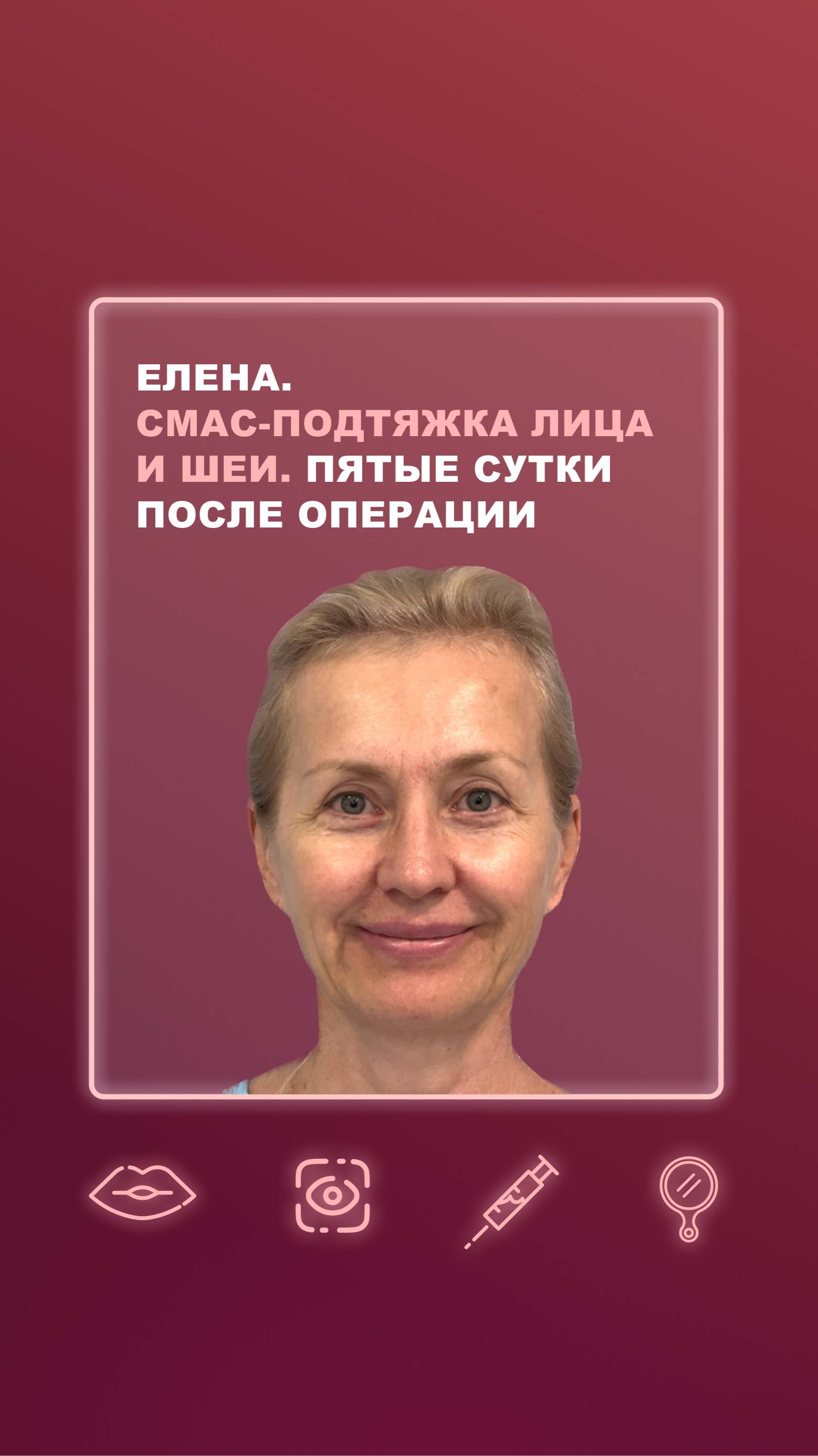 Елена. СМАС-подтяжка лица и шеи. Пятые сутки после операции