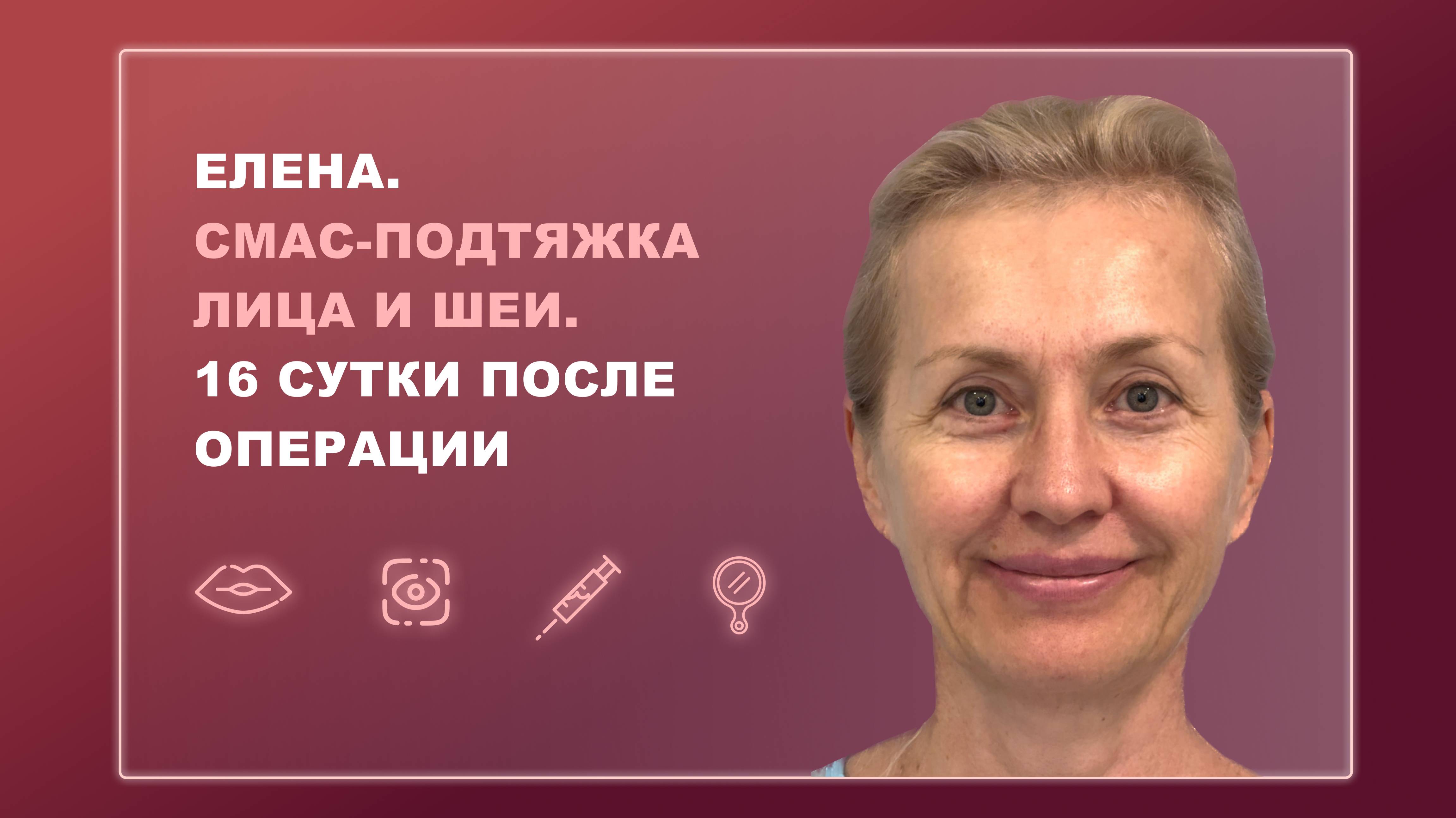 Елена. СМАС-подтяжка лица и шеи. 16 сутки после операции