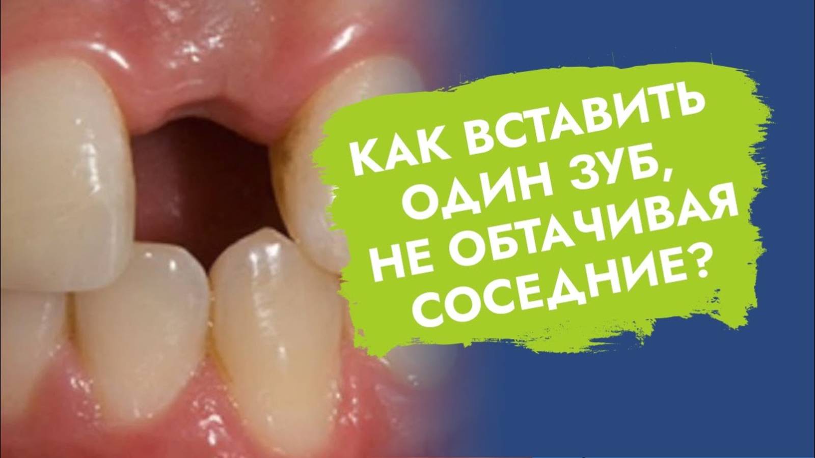 Методы протезирования одного утраченного зуба!