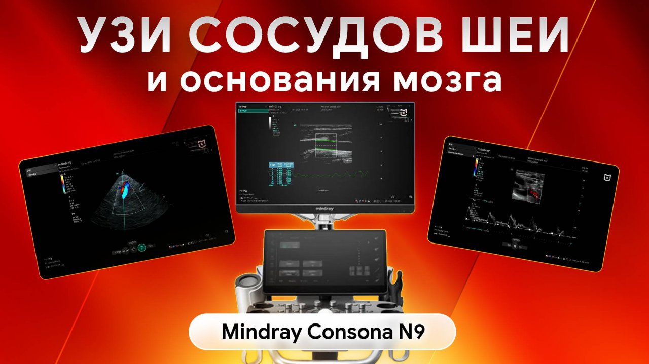 УЗИ сосудов шеи и основания мозга на Mindray Consona N9