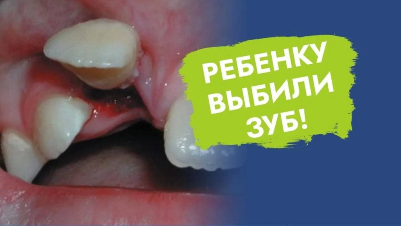 Можно ли спасти выбитый зуб?