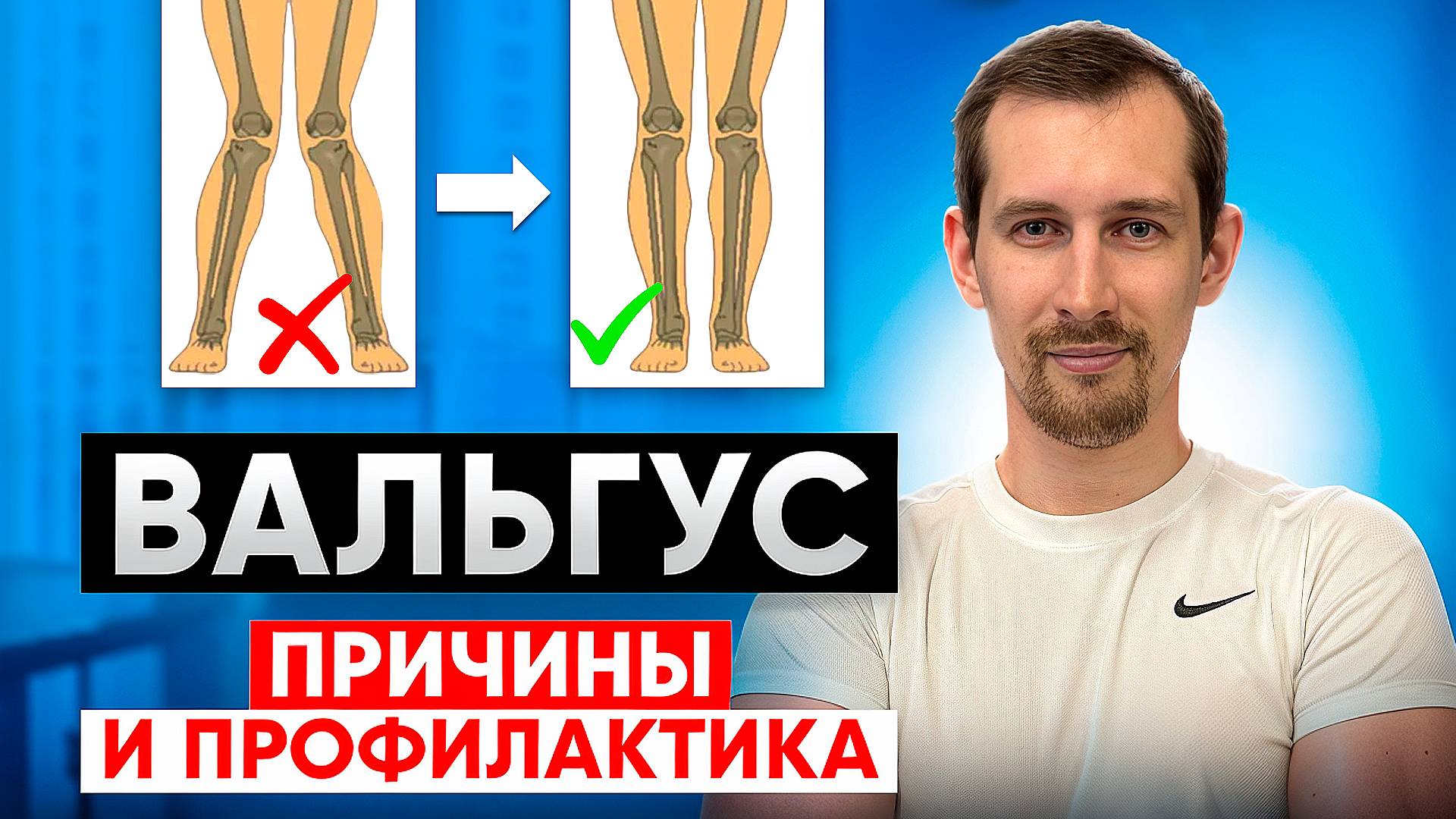 «Ноги иксом»: правильные шаги при вальгусной деформации!