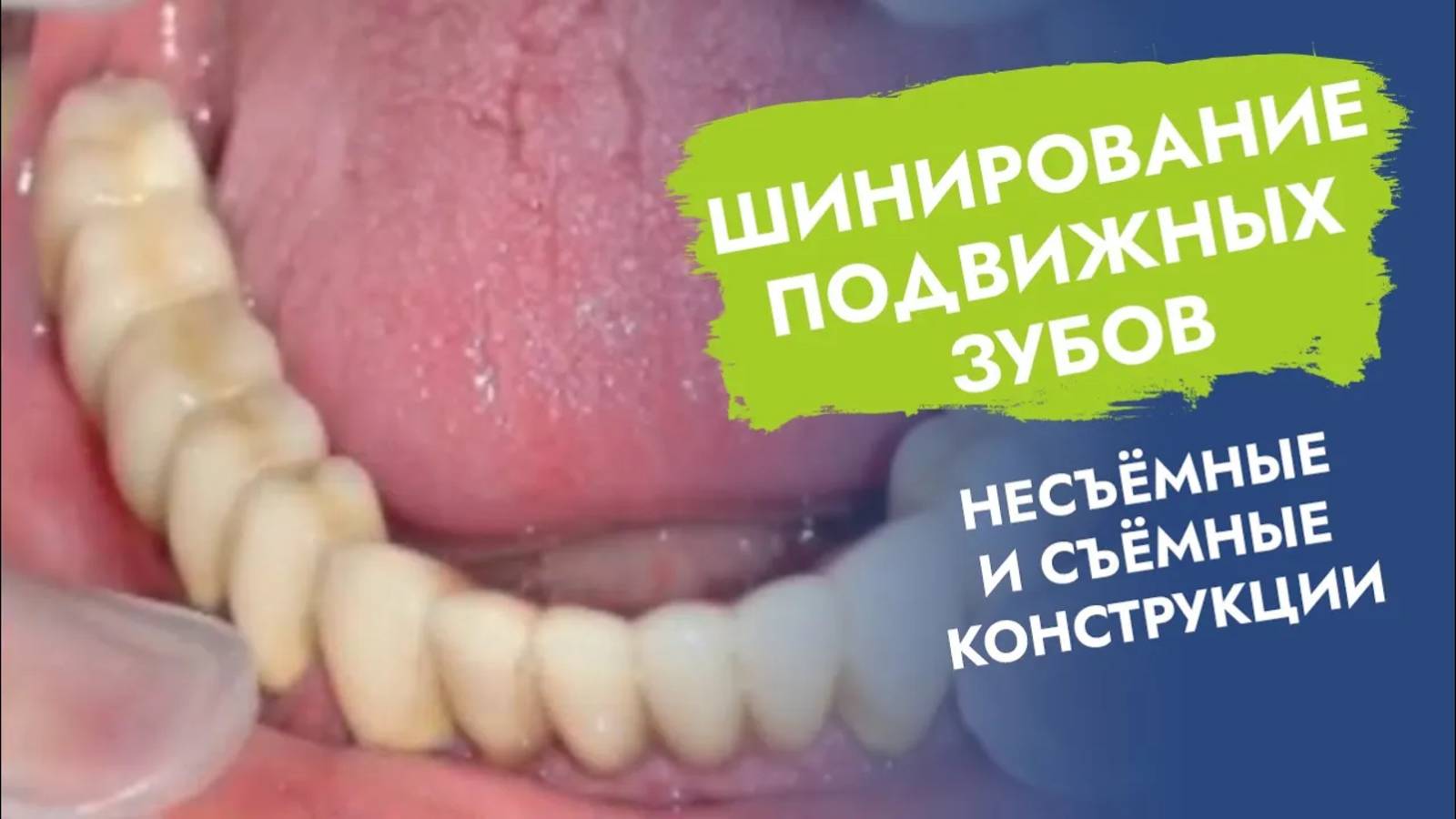 Как сохранить надолго подвижные зубы?