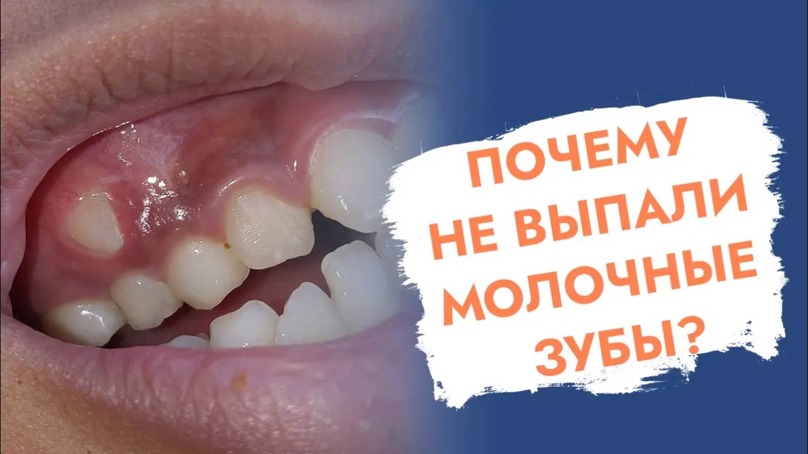 Что делать, если у взрослого не выпал молочный зуб?