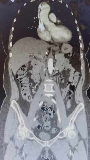 Опухоль двенадцатиперстной кишки на снимках КТ