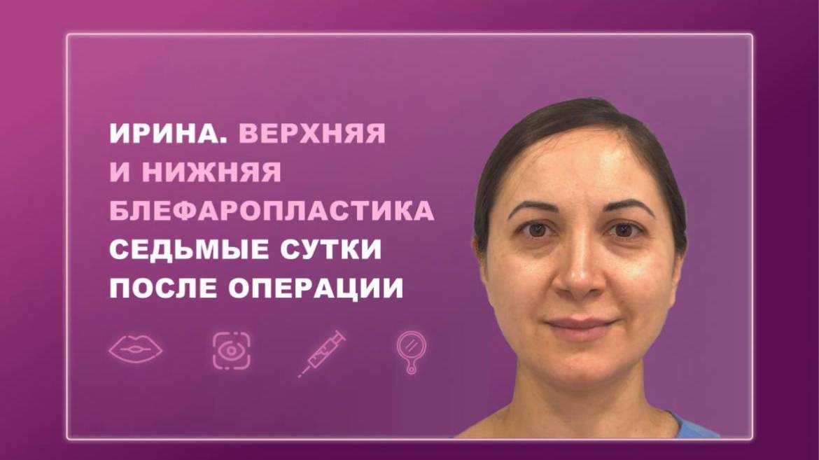 Ирина. Верхняя и нижняя блефаропластика. Седьмые сутки после операции