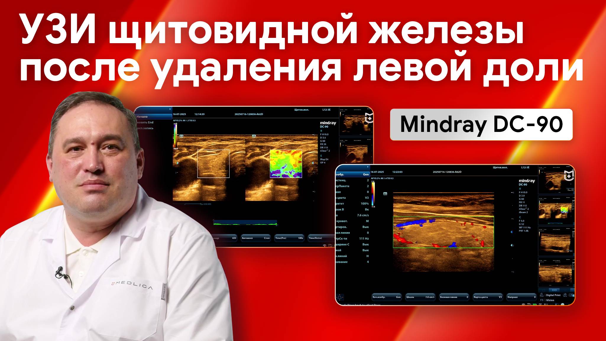 Мастер-класс: УЗИ щитовидной железы с удаленной левой долей на Mindray DC-90