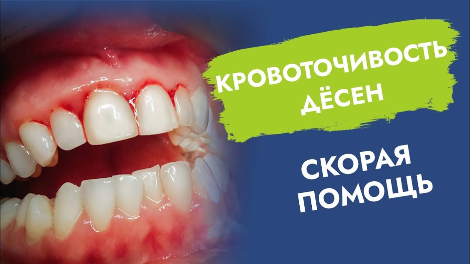Кровоточат десны. Как быстро устранить?