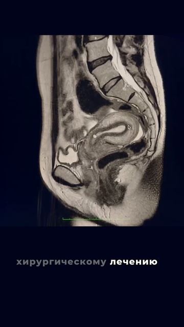 Эндометриальная карцинома на снимках МРТ
