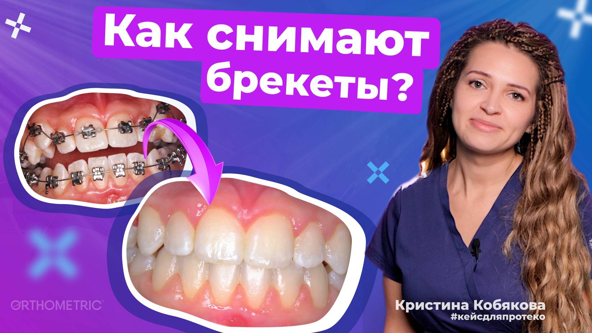 Сняли брекеты спустя год! Результат, который стоит увидеть