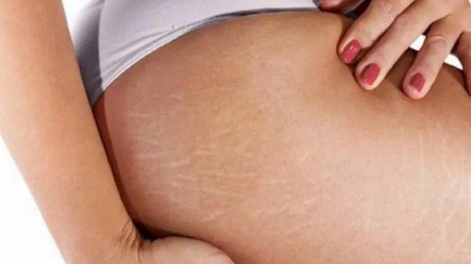 Как избавиться от растяжек